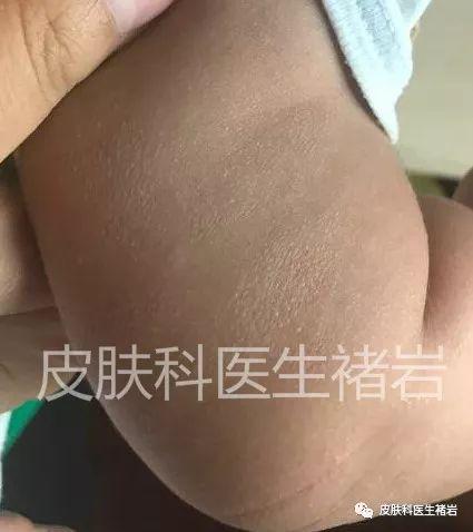 湿疹是什么样的（不同阶段湿疹的表现图片）